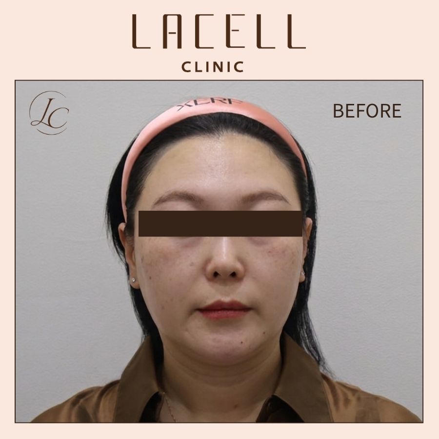 서**님(40대) 온다리프팅 전후 · 정면 · 치료 전