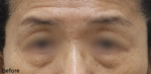 이**님 아이 울쎄라 전후 · 정면 · 치료 전