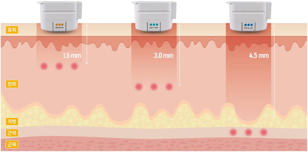 울쎄라피 프라임 전용 팁의 1.5mm, 3.0mm, 4.5mm 깊이 도해